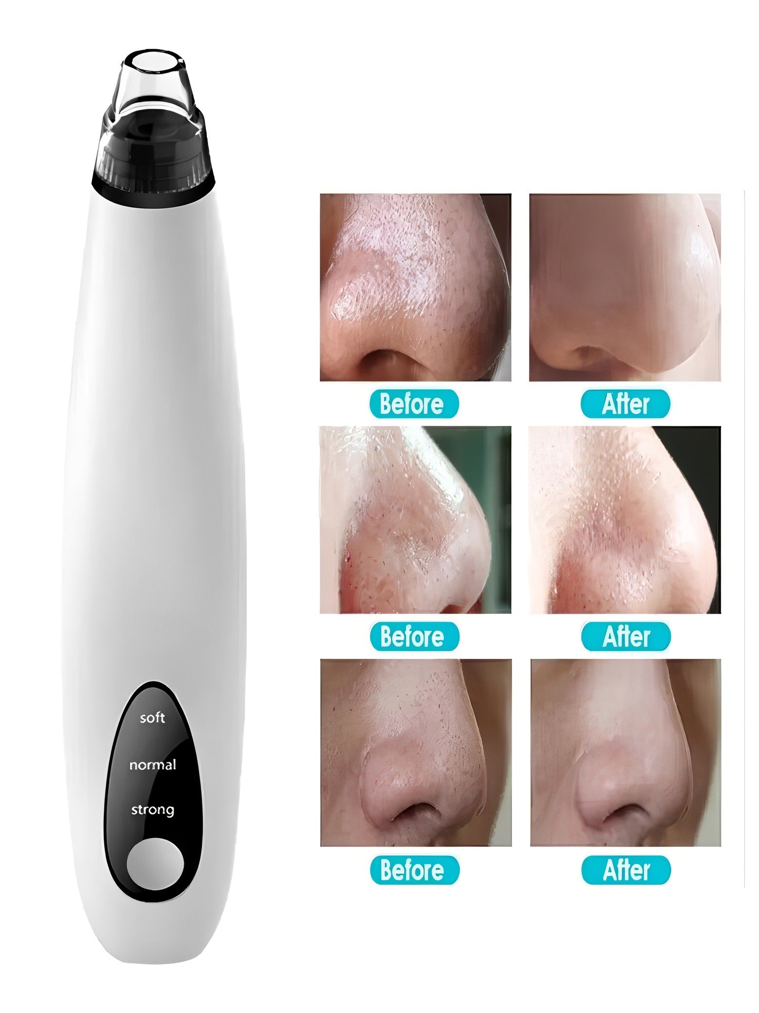 Electric Blackhead Remover & Pore Vacuum Cleaner